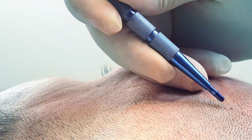أخبار الشركة الأخيرة عن تطبيق شفرات الزعفر في جراحة زرع الشعر